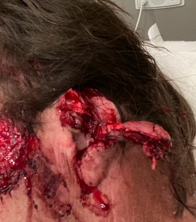 NESummerBaby83's tweet photo. Calm down people @MarkHamill was just pointing out the obvious. If you don't get it here's a great example first pic is my friends ear before the stitches and the 2nd one was after stitches and with his bandage. https://t.co/S84afUL9iF