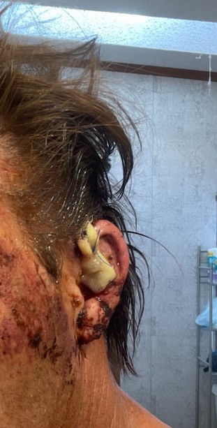 NESummerBaby83's tweet photo. Calm down people @MarkHamill was just pointing out the obvious. If you don't get it here's a great example first pic is my friends ear before the stitches and the 2nd one was after stitches and with his bandage. https://t.co/S84afUL9iF