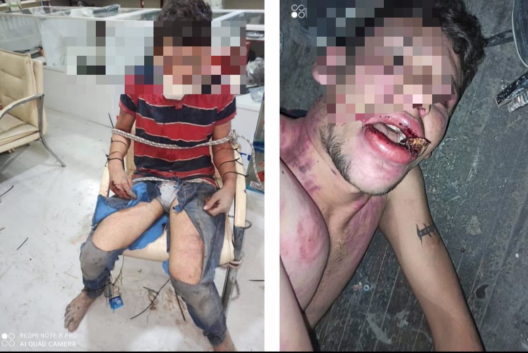 darkwebhaber's tweet photo. (HASSAS) Antalya'da 4 yıl önce bir oto bakım atölyesinde işe başlayan 22 yaşındaki Vedat Kurt, son aylarda verilmeyen maaşlarını işverenden istedi.

4 patron tarafından önce 3 gün boyunca aç susuz bir şekilde elektrik verilerek sopayla işkenceye maruz bırakılan, böcek yedirilen, dişleri kerpetenle çekilen Kurt, daha sonra 3 ay boyunca bir odada alıkonuldu. Yaraları iyileştikten sonra kaçmayı başaran Kurt, karakola giderek şikayetçi oldu.

4 kişiyi şikâyet etmesine ve HTS kayıtlarında işkence görüntülerinin çıkmasına rağmen zanlılar hakkında cezai yaptırım uygulanmadığını belirten Kurt, adalet çağrısında bulundu. (Mehmet Yetim)