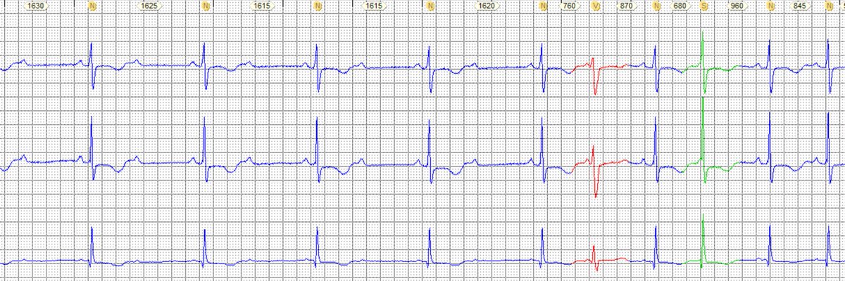 I am preparing a presentation on atrioventricular block and have selected this interesting case The Holter strips are from an asymptomatic 62y female patient. Ladder diagram next.<a href="/ecgandrhythmRoe/">Dr. Andreas Roeschl</a> <a href="/ecgandrhythmRoe/">Dr. Andreas Roeschl</a> <a href="/DidlakeDW/">David Didlake</a> <a href="/SergioPinski/">Sergio Pinski</a> <a href="/jeffrey_vinocur/">Jeffrey M Vinocur</a> <a href="/The_Nanashi_O/">Nanashī🫀</a>