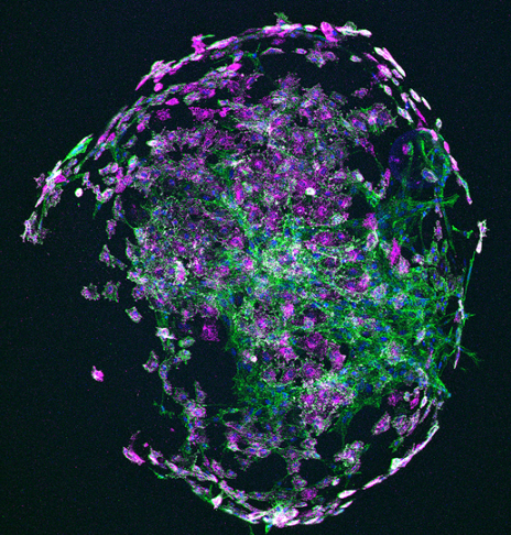 J Cell Science (@j_cell_sci) on Twitter photo Patricia Essebier <a href="/TEssebier/">Tish Essebier</a>, Lilian Schimmel, Emma Gordon @vesseldynamics & colleagues <a href="/IMBatUQ/">Institute for Molecular Bioscience</a> find that c-Src-induced vascular malformations require localised matrix degradation at focal adhesions.
Highlight: journals.biologists.com/jcs/article/13โฆ
Article: journals.biologists.com/jcs/article/13โฆ
#OpenAccess Patricia Essebier <a href="/TEssebier/">Tish Essebier</a>, Lilian Schimmel, Emma Gordon @vesseldynamics & colleagues <a href="/IMBatUQ/">Institute for Molecular Bioscience</a> find that c-Src-induced vascular malformations require localised matrix degradation at focal adhesions.
Highlight: journals.biologists.com/jcs/article/13โฆ
Article: journals.biologists.com/jcs/article/13โฆ
#OpenAccess