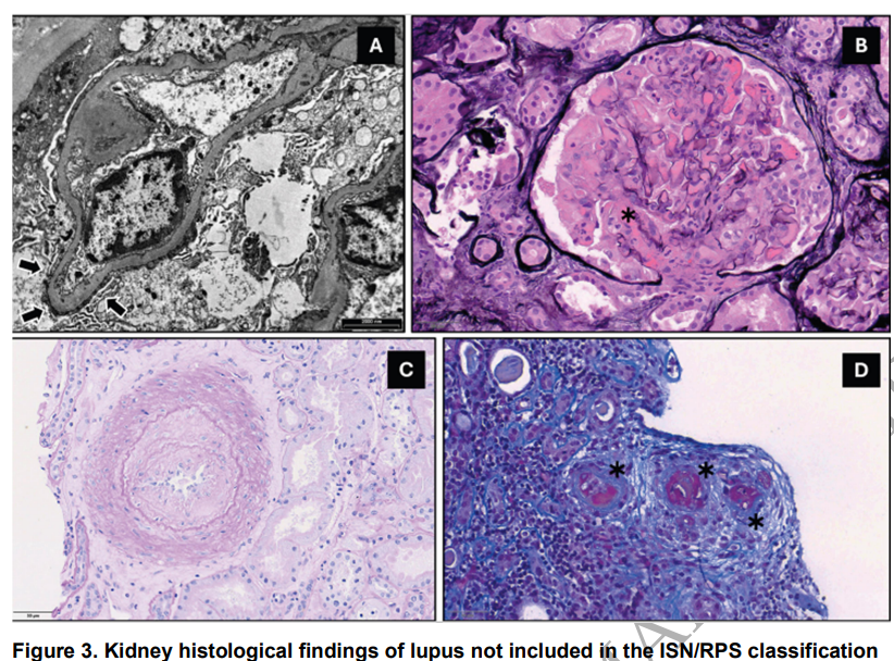 CKJsocial's tweet photo. Early-onset lupus nephritis

https://t.co/EF89rbtzaK

This Review focuses on the clinical &amp; histological aspects of early-onset LN aiming at highlighting relevant differences with adult patients emphasizing long-term outcomes &amp; discussing the management of long-term complications https://t.co/cxhJ153jXf