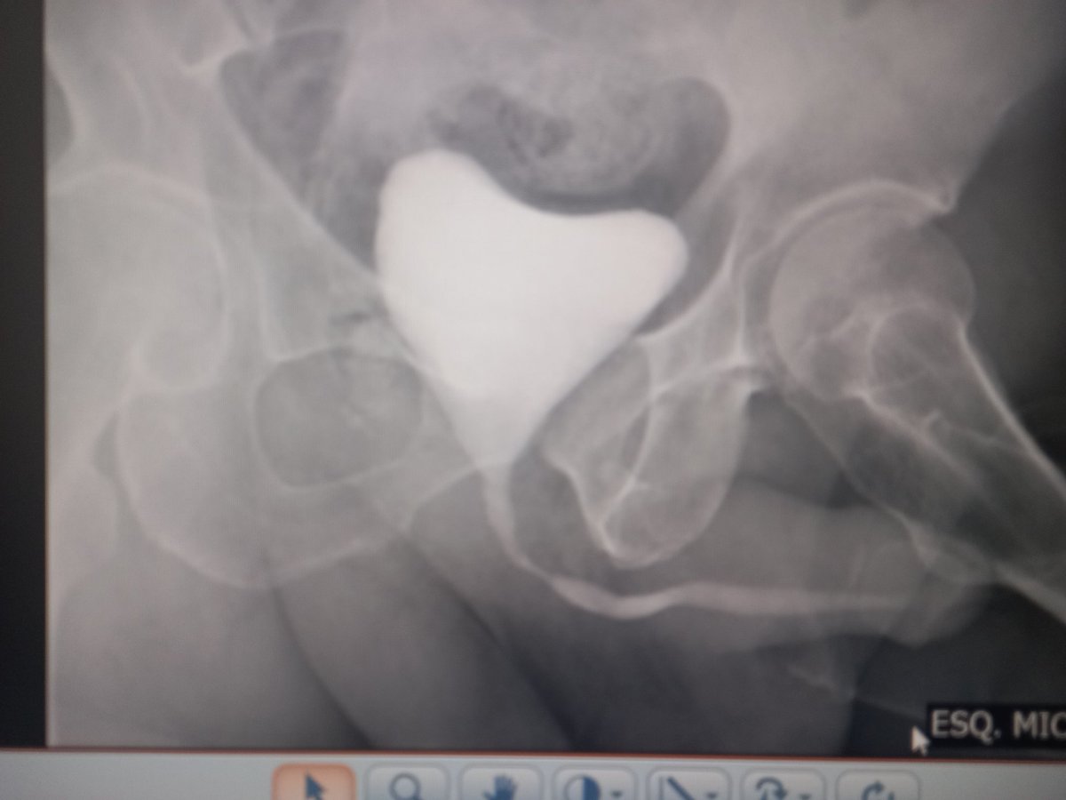 EPA X DORSAL ONLAY...RX is required in different incidents