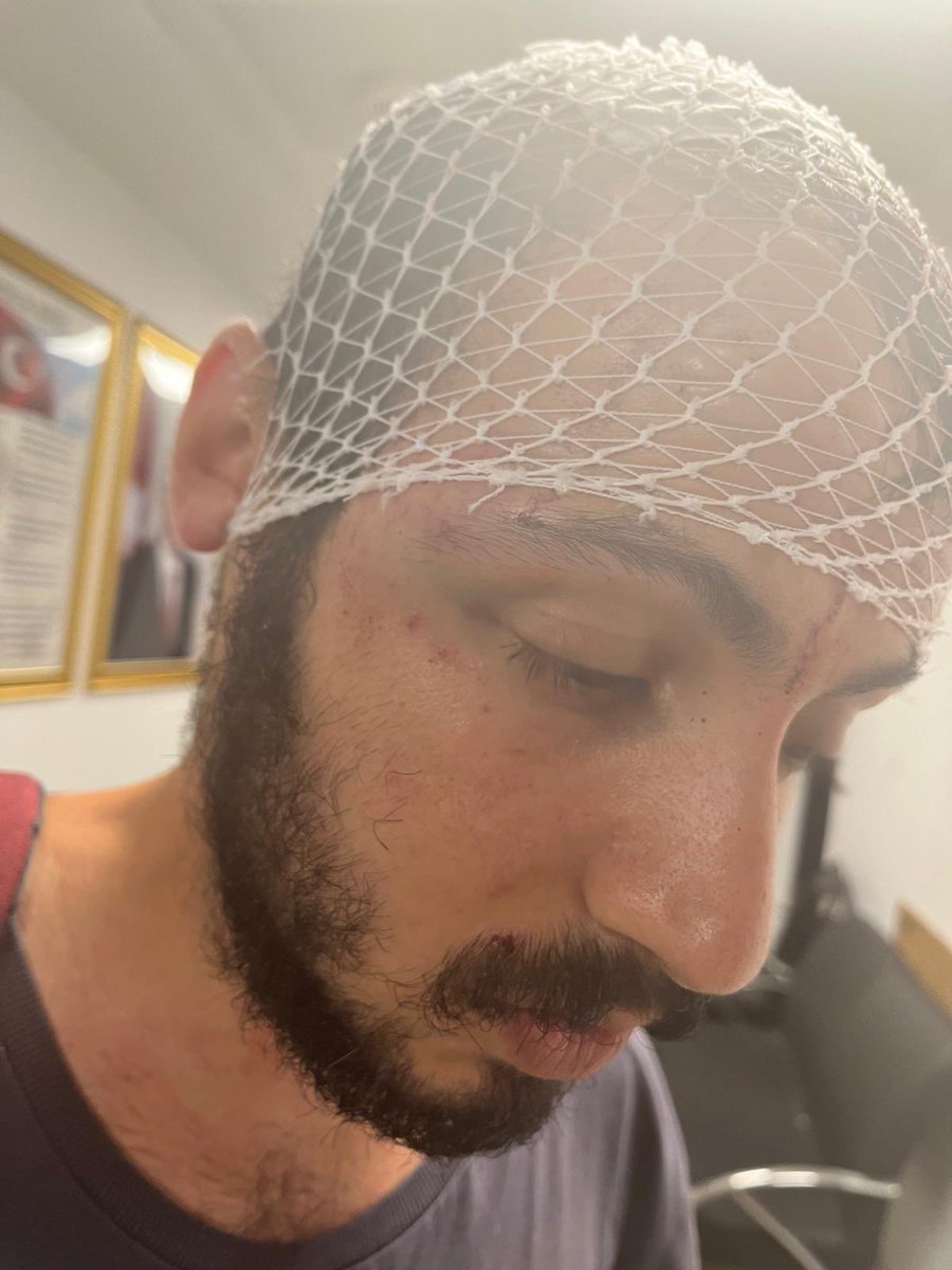 gokcekosedagi's tweet photo. Yine yetki aşımı, keyfi uygulama, yine bir insan hakkı ihlali ve işkence. 12 Temmuz akşamı Hasret Deniz Öçelik evinin yakınındaki tekel bayinden bira alıp içerek evine doğru yürüyor. Polisler önünü kesip GBT yapıyor. "Biranı çöpe at" diyor. Gözaltı talimatı veriliyor. Hiçbir mukavemet olmadan önden kelepçe yapılarak gözaltına alınıyor. Özçelik avukatını aramak istiyor. Polisler izin vermiyor. Özçelik, aramayı yapabiliyor ama avukatıyla konuşamıyor. Polisler nefesini kesecek kadar boğazını sıkıyorlar. 

Sağlık kontrolünün ardından polisin biri hastaneden çıkmak üzereyken "Sana ters kelepçe yapacağım" diyor. Hasret Deniz Özçelik de "Buna ne gerek var” diyor. Polisler zor kullansa da ters kelepçe yapamıyor. Tekrar önden kelepçe takıp araca götürüyorlar. Özçelik, araçta bir polis tarafından işkence görüyor ve bu hale getiriliyor. Kafasında üç zımbalı dikiş var. Vücudunda morluklar çizikler var. 

İki tarfın da ifade tutnaklarını okudum. Polis, Özçelik'in tüm bunları arabada eli kelepçeliyken kendi kendine yaptığını iddia ediyor. Hayatın olağan akışına aykırı... 

Özçelik gerekli hukuki işlemleri başlattı. Şikayetçi oldu. Türkiye İnsan Hakları Vakfı ile de temasta.