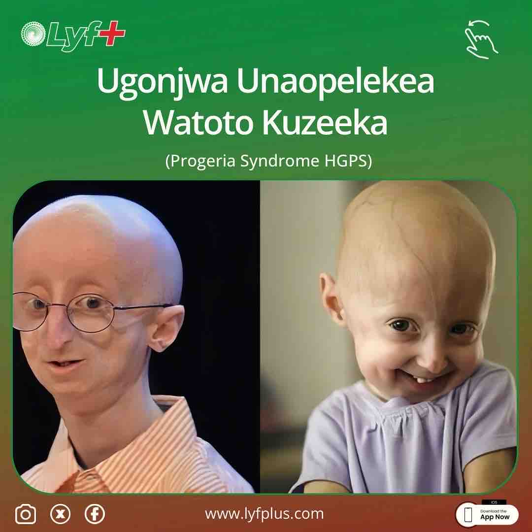 LyfPlusInc's tweet photo. Hutchinson-Gilford Progeria Syndrome (HGPS) ni ugonjwa unaosababisha kuzeeka kwa haraka kwa watoto. Dalili: kuchelewa kukua, ngozi inayoonekana imezeeka 🧓👴🏿, ugumu wa viungo 🤕. Hakuna tiba, lakini matibabu husaidia 🩺. #Progeria #children #lyfplus https://t.co/fAoCJVV1vm