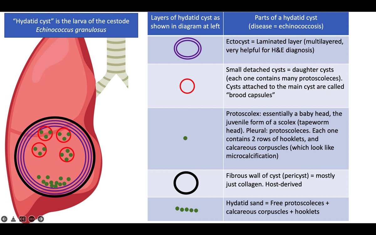 smlungpathguy's tweet image. Hydatid cyst, in simple language 

#Pathbugs #crittersontwitter #pathology #pulmpath #pathtwitter #medtwitter #idtwitter #infection #parasites #pathboards #knoworfail #echinococcosis #pathx