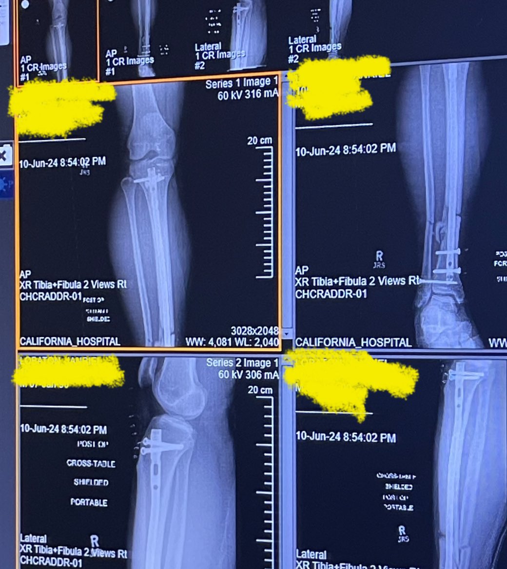 Croboi90's tweet photo. Hey #crofam ! It’s been 1 month since I’ve been hit by a hit and run driver. Recovery is grueling for my broken shin, cracked ribs and lacerated liver and kidney, 23 staples leaving me disabled for 8 months to a year leaving me out of work.

Anything helps, a share , a like, comments of positivity or any contribution. I’m truly grateful for my web3 communities!

https://t.co/WQTO1EjLwP

#GoFundMe