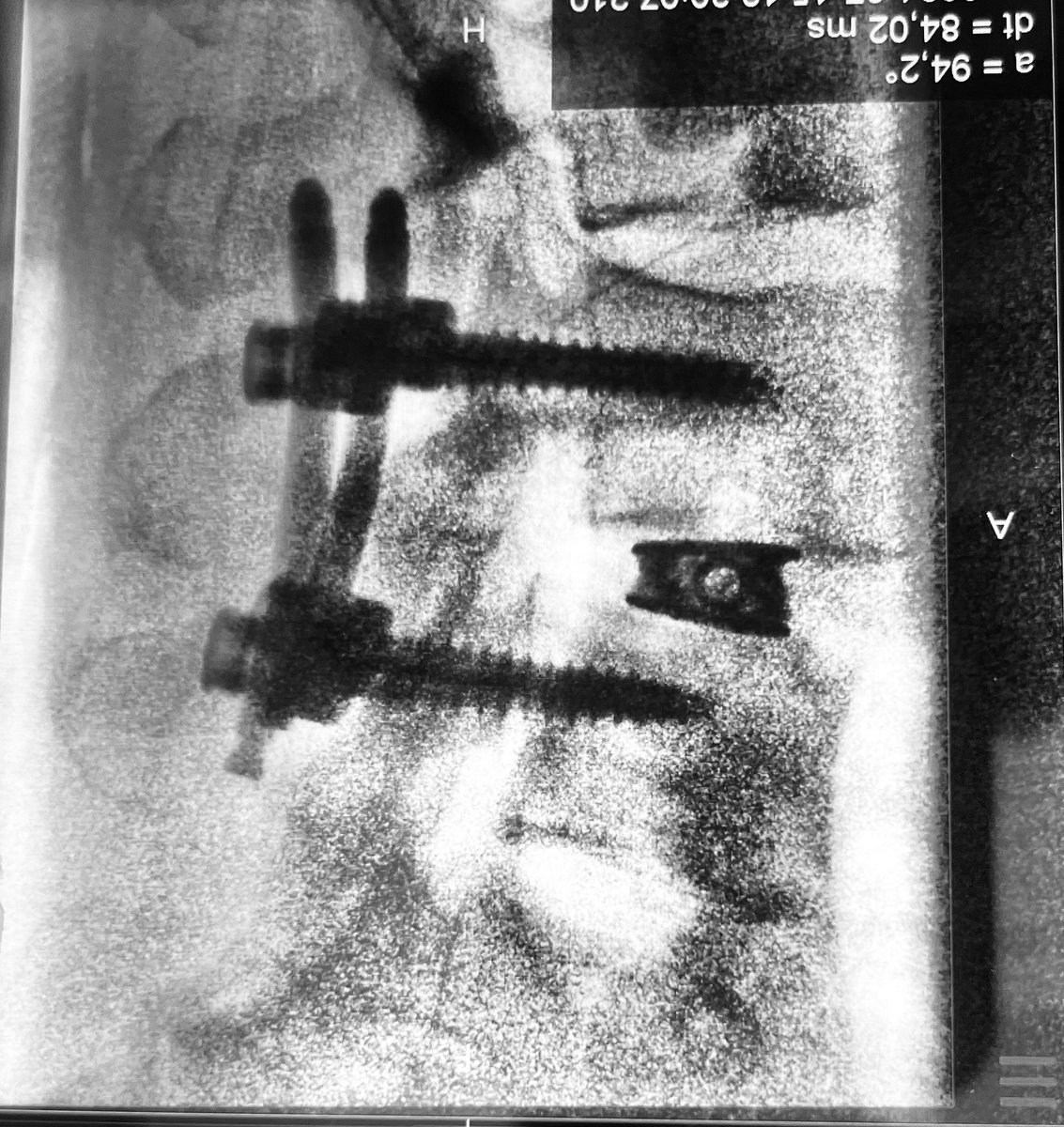 Single-position-prone-navigated LLIF. 

Doesn’t look like, but makes a lot of sense. 

Have you tried it?

<a href="/virtualspine/">Virtual Global Spine Conference</a> <a href="/atmghn/">A.T. Mameghani, MD 🇨🇭🇺🇦🇮🇱</a> <a href="/DrKatrin_Rabiei/">Katrin Rabiei MD, PhD</a> <a href="/vajkoczy/">Peter Vajkoczy</a>