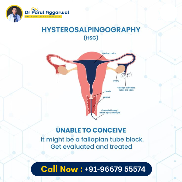 drparulaggarwal's tweet image. Curious about the Hysterosalpingogram (HSG) test? Discover how this essential procedure helps diagnose 

Book your consultation today - +919667955574

#HSGTest #FertilityCare #IVF #FertilityTesting #DrParulAggarwal #FertilitySpecialist #ParenthoodJourney #fertilitytreatment