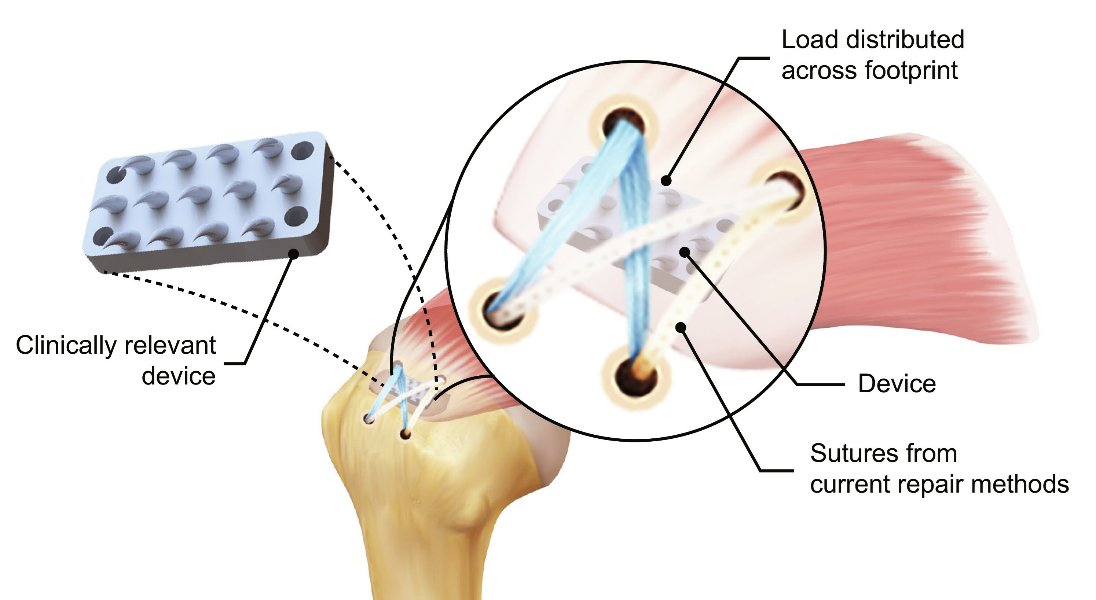 NIAMS (@nih_niams) on Twitter photo News: #NIAMSfunded researchers developed a python teeth-inspired device that may enhance rotator cuff repair. The 3D-printed device mimics a python’s ability to grasp soft tissue without tearing.
#OpenAccess via <a href="/ScienceMagazine/">Science Magazine</a>: science.org/doi/10.1126/sc… News: #NIAMSfunded researchers developed a python teeth-inspired device that may enhance rotator cuff repair. The 3D-printed device mimics a python’s ability to grasp soft tissue without tearing.
#OpenAccess via <a href="/ScienceMagazine/">Science Magazine</a>: science.org/doi/10.1126/sc…