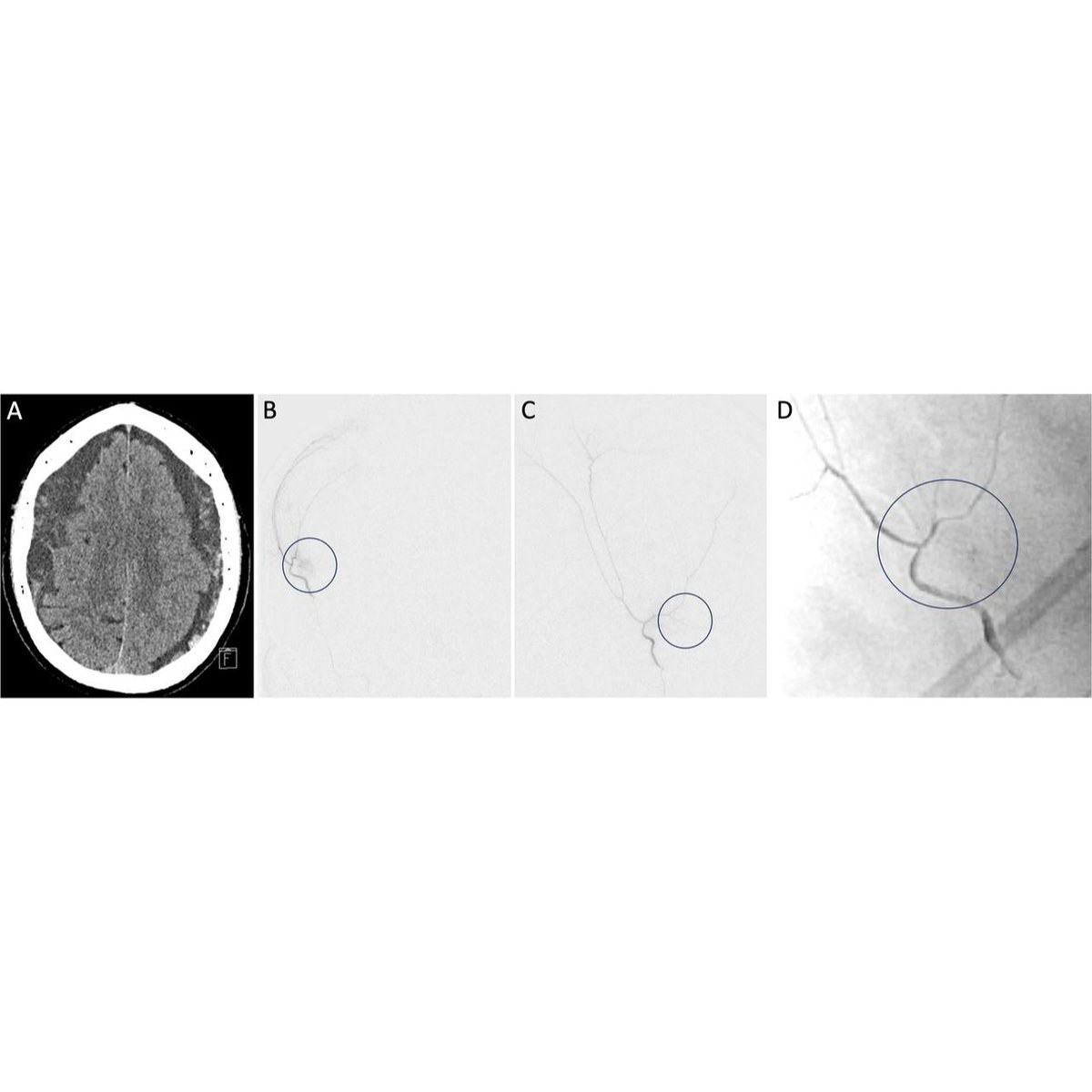 JNIS (@jnis_bmj) on Twitter photo First case of complete resolution of a meningioma following MMA embolization. Bilateral MMA embo for cSDH with small meningioma showing resolution of the tumor at 1 and 2 years. bit.ly/3W5OhSN <a href="/edowlati/">Ehsan Dowlati, MD</a> #MMA #meningioma First case of complete resolution of a meningioma following MMA embolization. Bilateral MMA embo for cSDH with small meningioma showing resolution of the tumor at 1 and 2 years. bit.ly/3W5OhSN <a href="/edowlati/">Ehsan Dowlati, MD</a> #MMA #meningioma