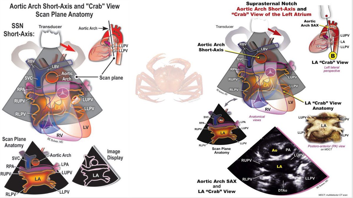 drEdgarFuentes's tweet image. 🦀 The “Crab View” by 2D/3D Echo… all you need to know❗️🦀 
Nice window to visualize 4-PV’s.

#echofirst

@iamritu @jusrtrysa12 @naty_ug @SONECOM_AC @Sochicaroficial @VazyurVasquez @jorgeachv @cardiopedhnn @ASE360 @ImagenCardiaca @VDelgadoGarcia @VerwerftJan @echo_stepbystep