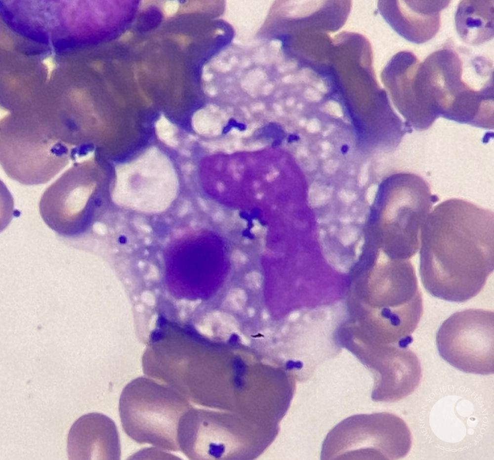 Hemophagocytosis figures following CART Cell Therapy 2 | ASH Image Bank | American Society of Hematology imagebank.hematology.org/image/64922/he… #ASHImageBank