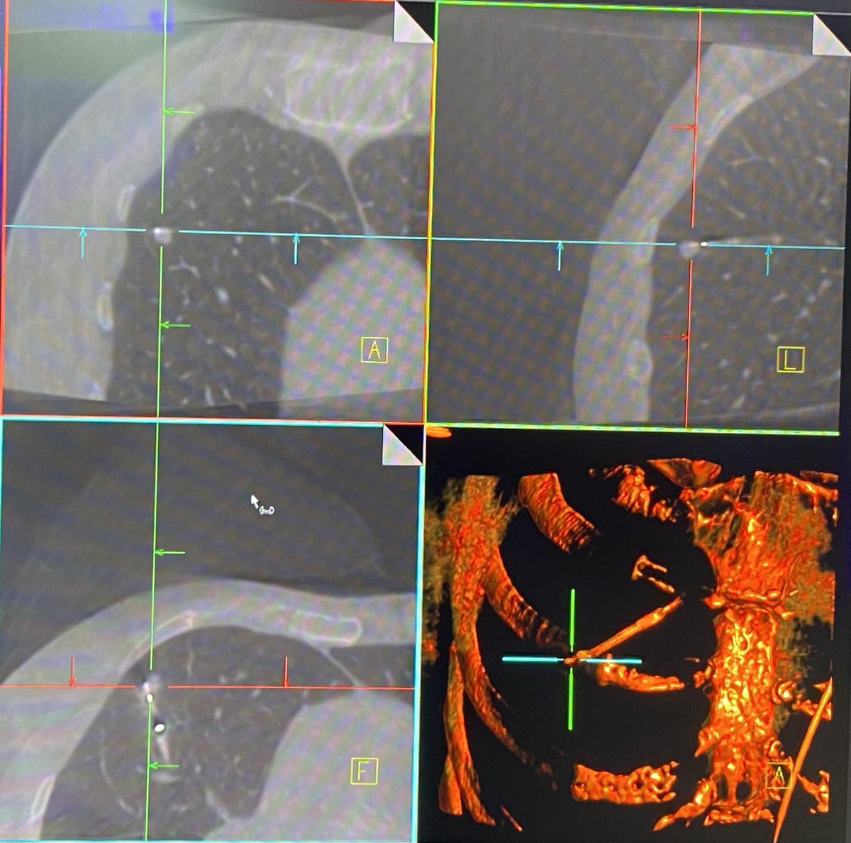 6 mm right upper lobe nodule and tool in target confirmation with CIOs Spin 3D imaging during robotic bronchoscopy with Ion intuitive system; important for a patient with renal cell carcinoma to rule out metastasis!