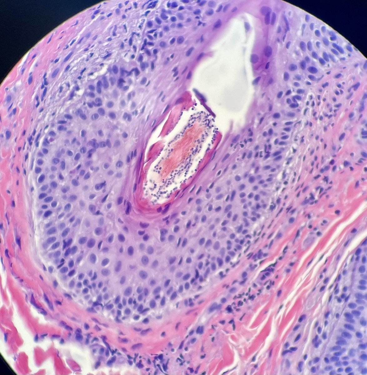 Another fungus case with no need for PAS :)  #dermatology #dermpath #tinea #endothrix