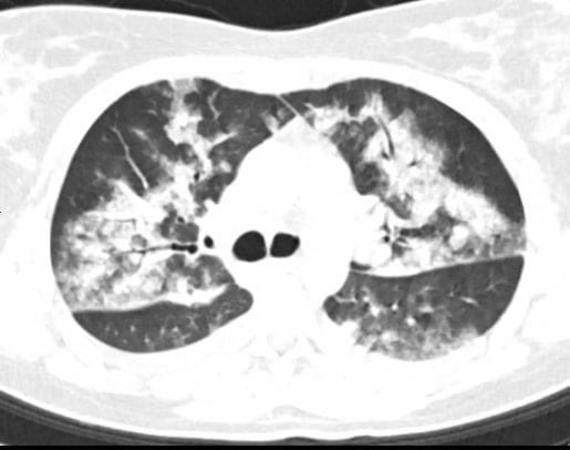 hemo_shk's tweet photo. #Chest_CT
A 32 years old female who developed sudden onset of shortness of breath after blood transfusion.
Q)What are your imaging findings and diagnosis?
#MEDHM https://t.co/dKqg13EpTz