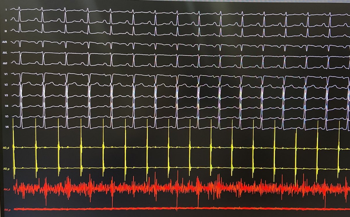 José Alderete M (@jalderetem) on Twitter photo Very interesting case today with <a href="/FedericoLandra1/">Federico Landra</a>
44 y/o 👨🏻 with palpitations and mildly depressed LVEF.
1) Baseline ECG
2) Holter 24h monitoring
3) EP lab recordings (Abl catheter at His)
4) Final ECG
What’s the diagnosis? What did we ablate? <a href="/DrBerruezo/">DrAntonioBerruezo</a> #Epeeps Very interesting case today with <a href="/FedericoLandra1/">Federico Landra</a>
44 y/o 👨🏻 with palpitations and mildly depressed LVEF.
1) Baseline ECG
2) Holter 24h monitoring
3) EP lab recordings (Abl catheter at His)
4) Final ECG
What’s the diagnosis? What did we ablate? <a href="/DrBerruezo/">DrAntonioBerruezo</a> #Epeeps