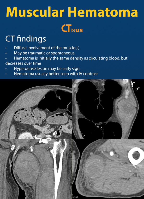 Muscular Hematoma 