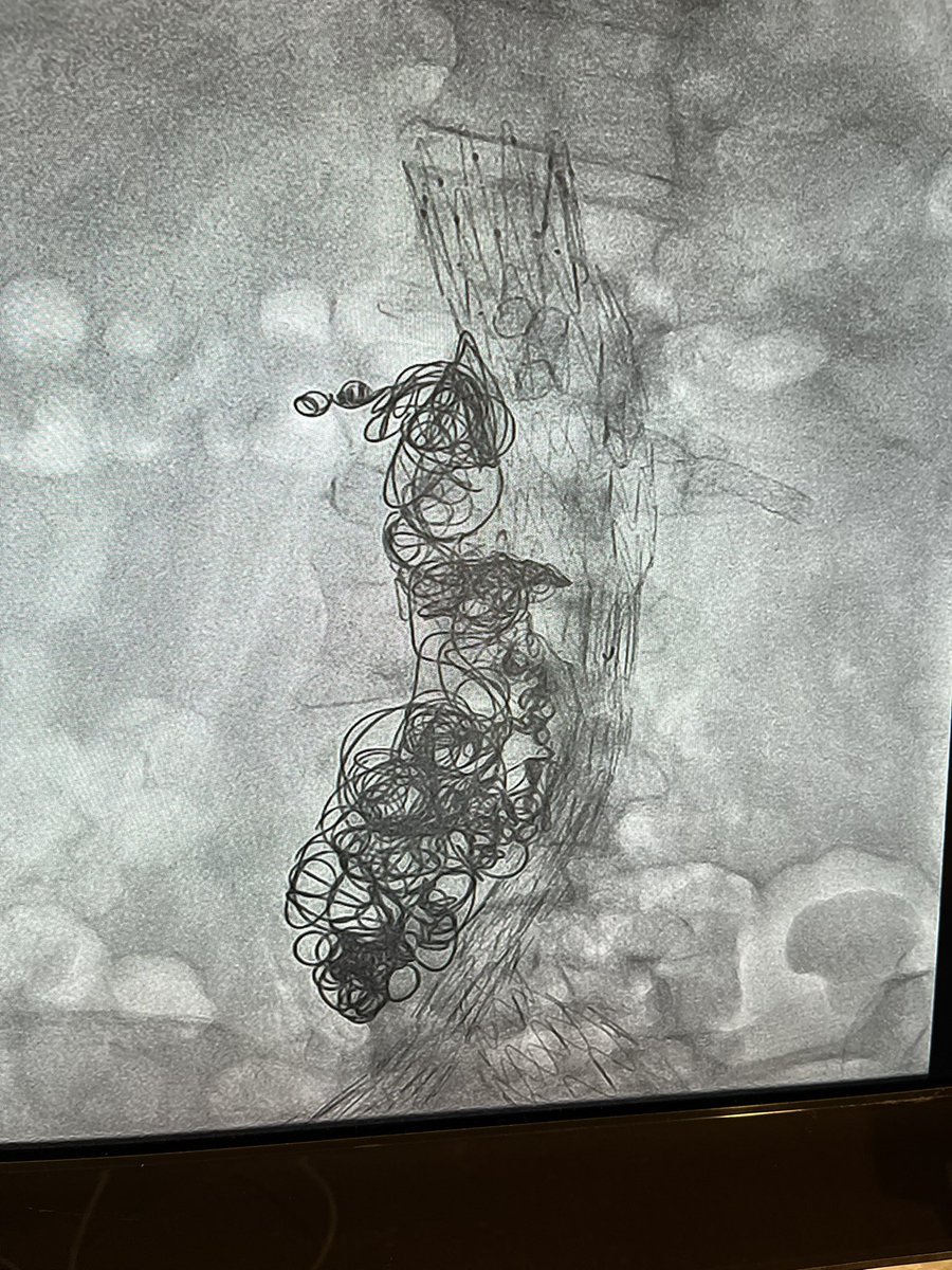 IssamVasc's tweet photo. Been a long time coming… my first #transcaval case! @terumois #CallVascular #SurgeryIsOnlyPartOfOurStory #AortaEd
What’s your record number of coils implanted? https://t.co/z4UIOG3tVA