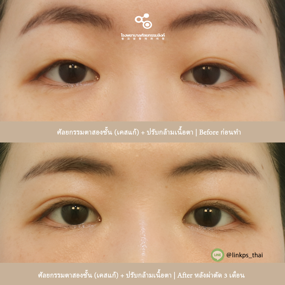 linkpsthai's tweet photo. ศัลยกรรมตาสองชั้น (เคสแก้) + ปรับกล้ามเนื้อตา | Before ก่อนทำ และ ก่อน-หลังผ่าตัด 3 เ���ือน
💙 X(twitter) : @linkpsthai 
#โรงพยาบาลศัลยกรรมลิงค์ #รพศัลยกรรมลิงค์ #รพลิงค์ #หมอจองมินซู #หมอชองฮามิน #ศัลยกรรมเกาหลี https://t.co/IOqyTQfKN0