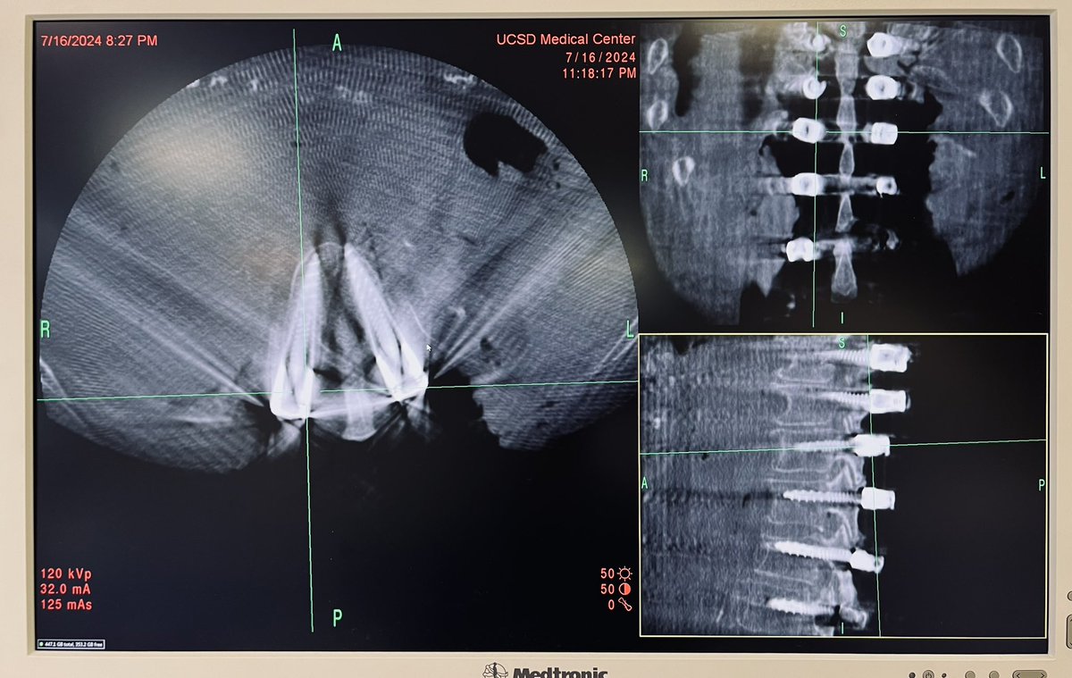 Martin H. Pham, MD (@martinphammd) on Twitter photo Another successful sub-I spine cadaver lab — freehand pedicle screw placement, laminectomies, facetectomies, and even got to pedicle subtraction. This applicant season is looking bright!
<a href="/UCSDNeuroSurg/">UC San Diego Neurological Surgery</a> <a href="/CFS_UCSD/">Center for the Future of Surgery</a> Another successful sub-I spine cadaver lab — freehand pedicle screw placement, laminectomies, facetectomies, and even got to pedicle subtraction. This applicant season is looking bright!
<a href="/UCSDNeuroSurg/">UC San Diego Neurological Surgery</a> <a href="/CFS_UCSD/">Center for the Future of Surgery</a>