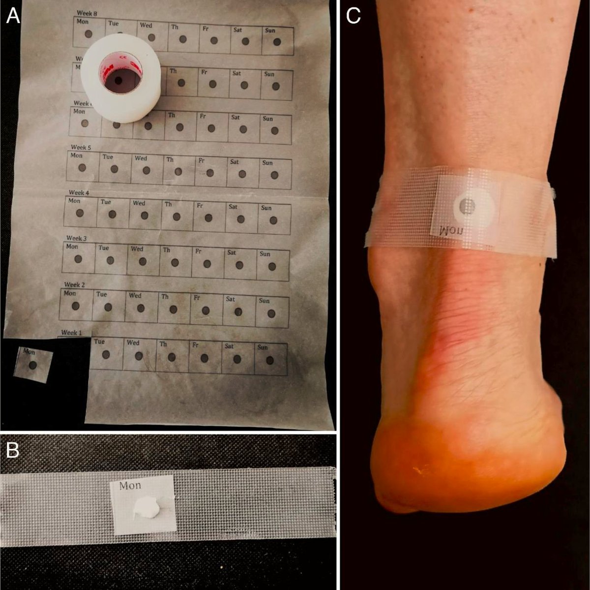 Topical glyceryl trinitrate (GTN) and eccentric exercises in the treatment of mid-portion achilles tendinopathy (the NEAT trial): a randomised double-blind placebo-controlled trial

👇👇👇

pubmed.ncbi.nlm.nih.gov/39013615/