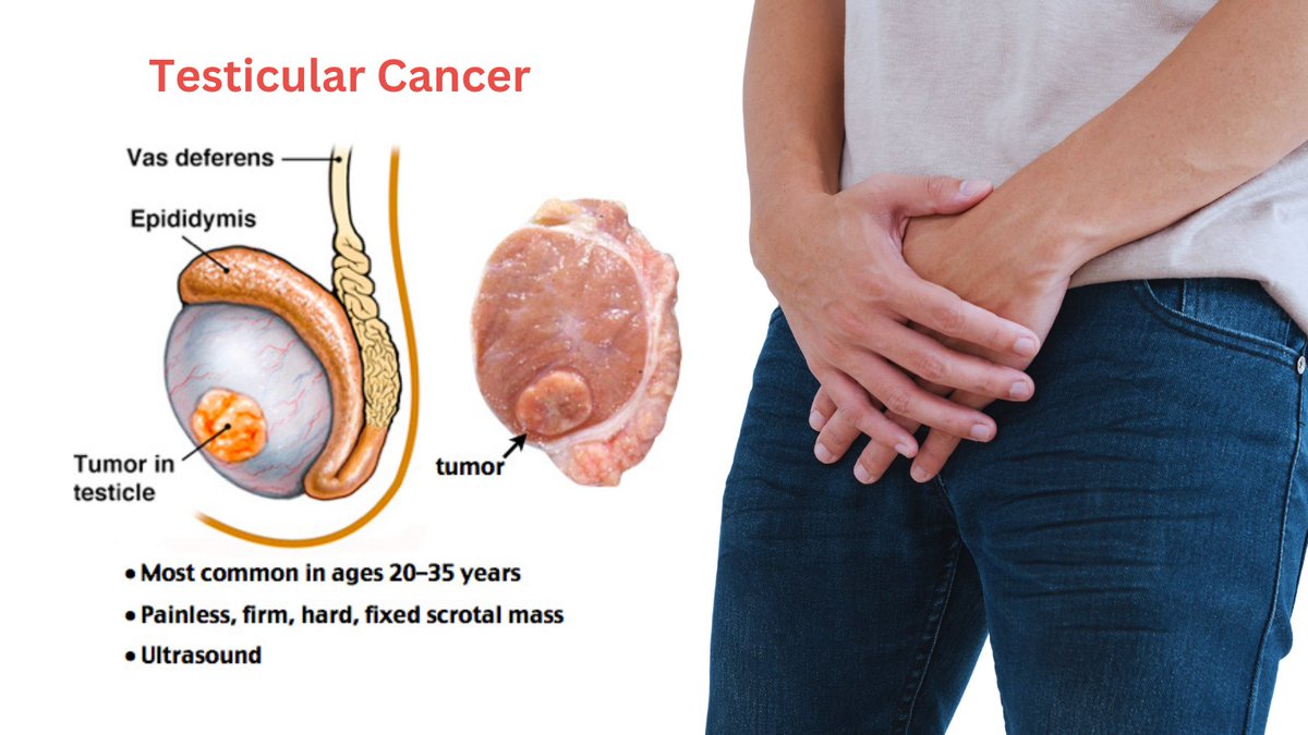 𝐓𝐞𝐬𝐭𝐢𝐜𝐮𝐥𝐚𝐫 𝐜𝐚𝐧𝐜𝐞𝐫 can be detected early through regular self-exams. Early detection is key for successful treatment. Consult your doctor if you notice any changes. #TesticularCancer #Urology #urologydoctor #drnadeembinnusrat #nadeembinnusrat #urologistinpakistan