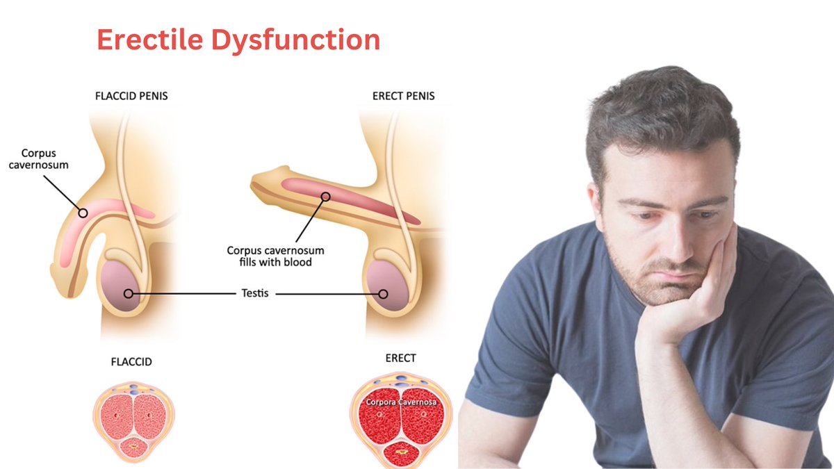 𝐄𝐫𝐞𝐜𝐭𝐢𝐥𝐞 𝐝𝐲𝐬𝐟𝐮𝐧𝐜𝐭𝐢𝐨𝐧 can be a sign of underlying health issues such as cardiovascular disease. Treatments include medications, lifestyle changes, and therapy. #ErectileDysfunction #Urology #urologydoctor #drnadeembinnusrat #nadeembinnusrat #urologistinpakistan