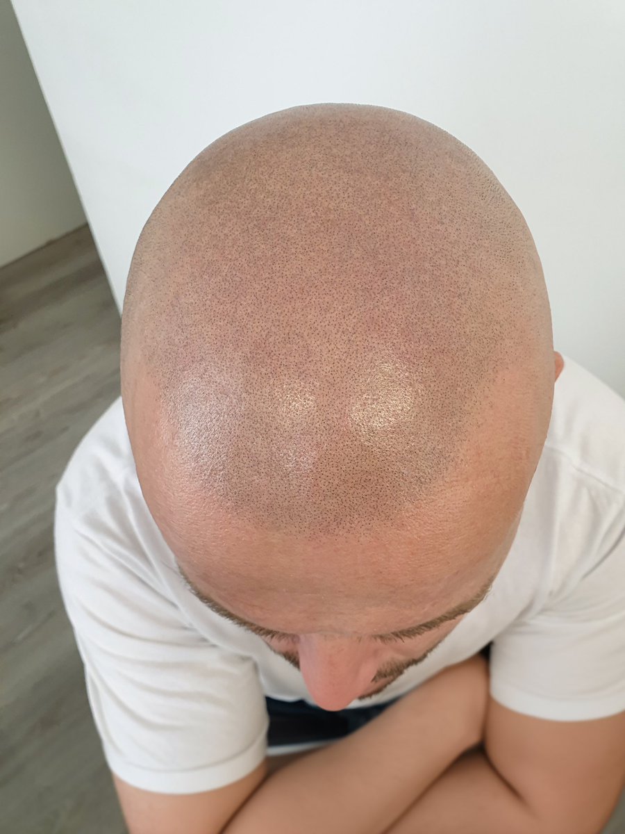 SkalpWorldwide's tweet image. Discover a permanent solution for hair loss with Skalp’s Scalp Micropigmentation treatment. Regain your confidence today!

This is our client after his 2nd session.

#skalp #scalpmicropigmentation #SMP #hairtattoo #scalptattoo #hairlinetattoo #hairrestoration #hairlosssolution