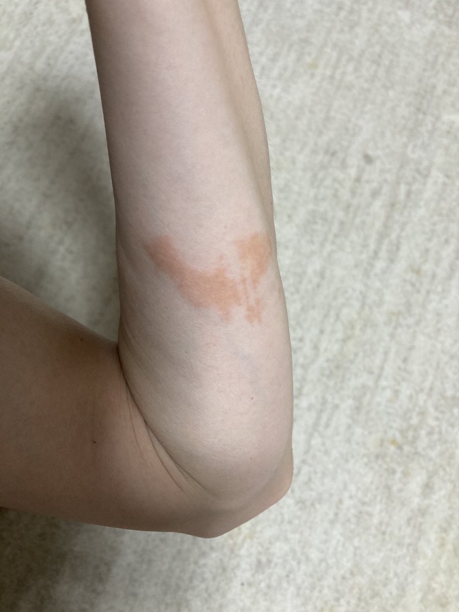 matsuri81's tweet photo. シェディング、めっちゃ痒い😭3日前に合気道の体験に行ったのだけど、相手の方がすごいワクチン臭で、解毒されてないなーって思ってたら案の定、掴まれた腕がプクーって膨れてきた。手からスパイク蛋白出てるのよね。擦り傷と思って眺めてたら、形がちょうど指の形してて昨日ハッと気がついた！ https://t.co/3iDdbLSTmk