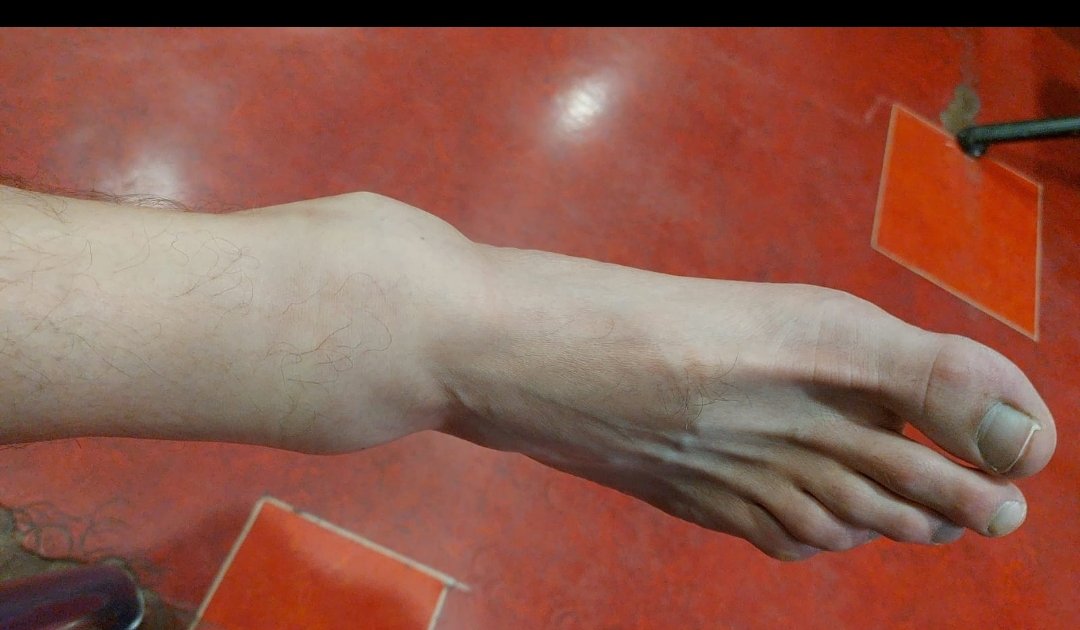 EnzoCocozza's tweet photo. Happy summer everyone, bi-malleolar ankle fracture in self defense 🤕
Stay positive 🫡

￼ https://t.co/XsMIgf9SzB