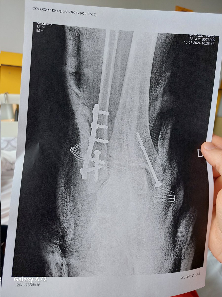 EnzoCocozza's tweet photo. Happy summer everyone, bi-malleolar ankle fracture in self defense 🤕
Stay positive 🫡

￼ https://t.co/XsMIgf9SzB