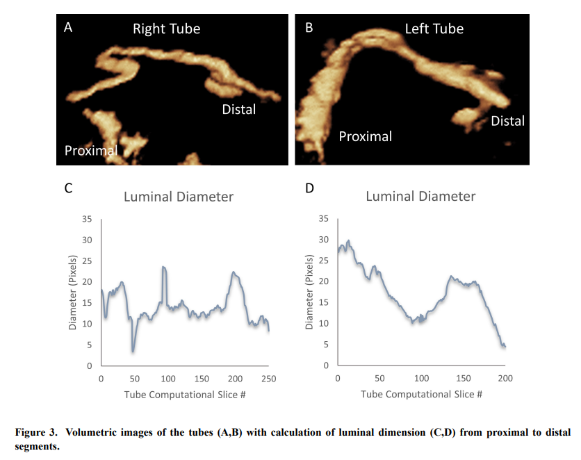 EJGO_1980's tweet photo. Short Communications #EJGO 🎉🎉
Enhanced sonographic depiction of the distal fallopian tube: preliminary findings using a new volumetric technique
🔓Full article: https://t.co/aC6LfEIsDV
#VolumetricSonography #FallopianTubes #DistalFallopianTubes https://t.co/MQaHFZ0yo8