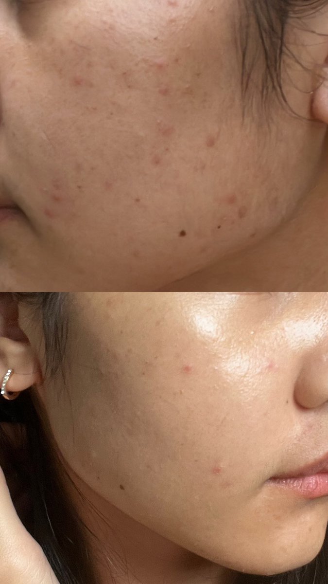 pipro8's tweet photo. ลูกรัก!!! ยกขึ้นแท่น skincare กอบกู้ผิว

 ก่อนใช้ : บอกเลยว่าไปลุยมาอย่างหนักหน่วงกับการไปเที่ยวล่องแพ แล้วผิวโทรมหนักมากก

ผลลัพธ์หลังใช้ไม่ถึง 2 อาทิตย์ โอ้แม่เจ้า จะใช้ตลอดไป แล้วช่วงกอบกู้ผิวใช้แค่ตัวนี้กับกันแดด
พิกัด : https://t.co/OWCFY2zpnY 
#รีวิวช้อปปี้  #สกินแคร์ #สิว https://t.co/bZpfkmLIU7