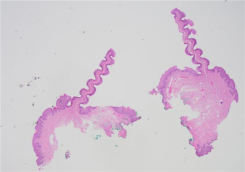 drtimbracey's tweet photo. Perhaps I’ve had too much coffee but the forceps artefact in this skin biopsy shared with me by @ssaunders279 reminded me of the clashing tusks of a pair of rutting narwhals #pathart #dermpath @ACP_Pathologist https://t.co/ntwVt3tBfs