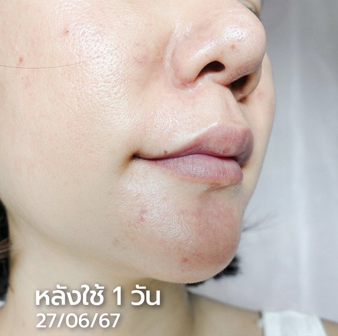 รีวิวไม่รู้กี่ครั้ง..ต่อกี่ครั้ง สำหรับ Eucerin ✨ คือฉันเป็นทาสรักนางสุดๆ🥰 โดยเฉพาะไลน์ Pro Acne Solution คือเค้าทำดี ทำถึง!! ช่วงไหนที่สิวปะทุหนักๆ💢 ก็จัดไปเลย Eucerin SOS Serum ตัวนี้ นางเป็นเซรั่มที่ช่วยจัดการสิว แบบเร่งด่วนใน 8ชม.🕗 ช่วยลดการอักเสบ ด้วยสารลดอักเสบx2