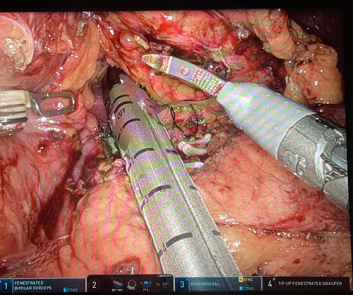 Frank Vela (@ffrank_vp) on Twitter photo Ahora a esperar un poco!! Robotic distal pancreatectomy 🚀🚀 con <a href="/pmuriel_al/">Pablo Muriel</a>
Pancreas Team <a href="/Hbp_EgLleida/">Cirugía HBP y Gástrica H. Arnau de Vilanova Lérida</a>
<a href="/aecirujanos/">aecirujanos</a> <a href="/hpb_so/">SoMe4HPB</a> <a href="/aecformacion/">AEC Formación</a> <a href="/SCatCir/">Societat Catalana de Cirurgia</a> Ahora a esperar un poco!! Robotic distal pancreatectomy 🚀🚀 con <a href="/pmuriel_al/">Pablo Muriel</a>
Pancreas Team <a href="/Hbp_EgLleida/">Cirugía HBP y Gástrica H. Arnau de Vilanova Lérida</a>
<a href="/aecirujanos/">aecirujanos</a> <a href="/hpb_so/">SoMe4HPB</a> <a href="/aecformacion/">AEC Formación</a> <a href="/SCatCir/">Societat Catalana de Cirurgia</a>