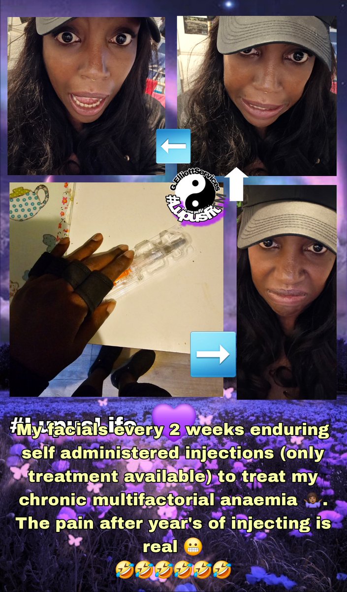 GeorgiaEinstein's tweet photo. #TuesdayThoughts 🤔 It should get easier injecting yourself in the stomach over the year's for multifactorial #aneamia which can only be treated with this medication. Pain is real. Thinking  skin is fed up being a pin cushion🤣 #lupus #life #lupusawareness Lupusfit™️ 🫶🏿🙌🏿🖤💜🌍💯 https://t.co/8MzYGgGTrY