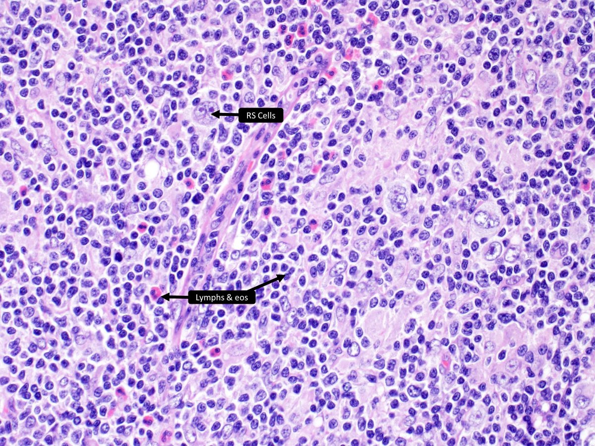 DrCycloPath's tweet photo. 1st impression diagnosis? 
Mediastinal _____
a) nodular sclerosis CHL
b) NLP Hodgkin lymphoma
c) large B-cell lymphoma
d) grey zone lymphoma
#HemePath #PathTwitter #pathology 
🔬https://t.co/PFtF9r22GP https://t.co/a1P91McxMo