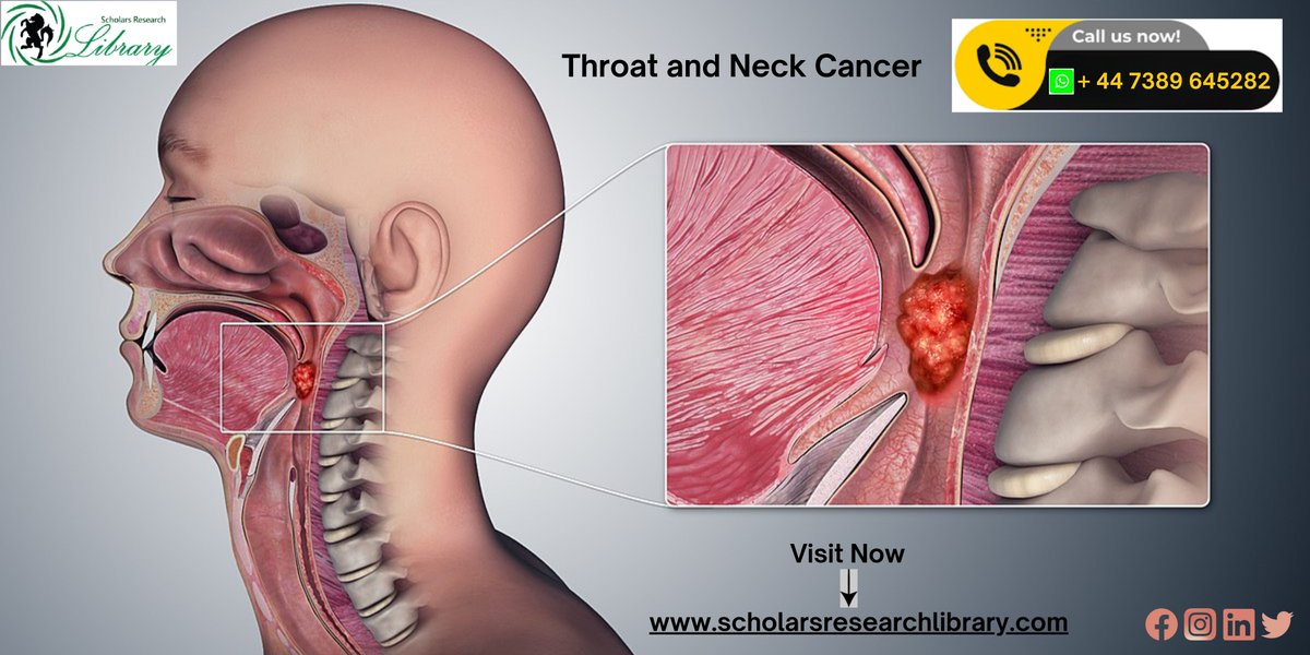 ScholarsResear2's tweet image. Throat and Neck Cancer is a serious health concern affecting many individuals worldwide. Learn about symptoms, risk factors, and treatment options in our latest article. Early detection is key! 🦋 #cancerawareness #healtheducation #spreadtheknowledge