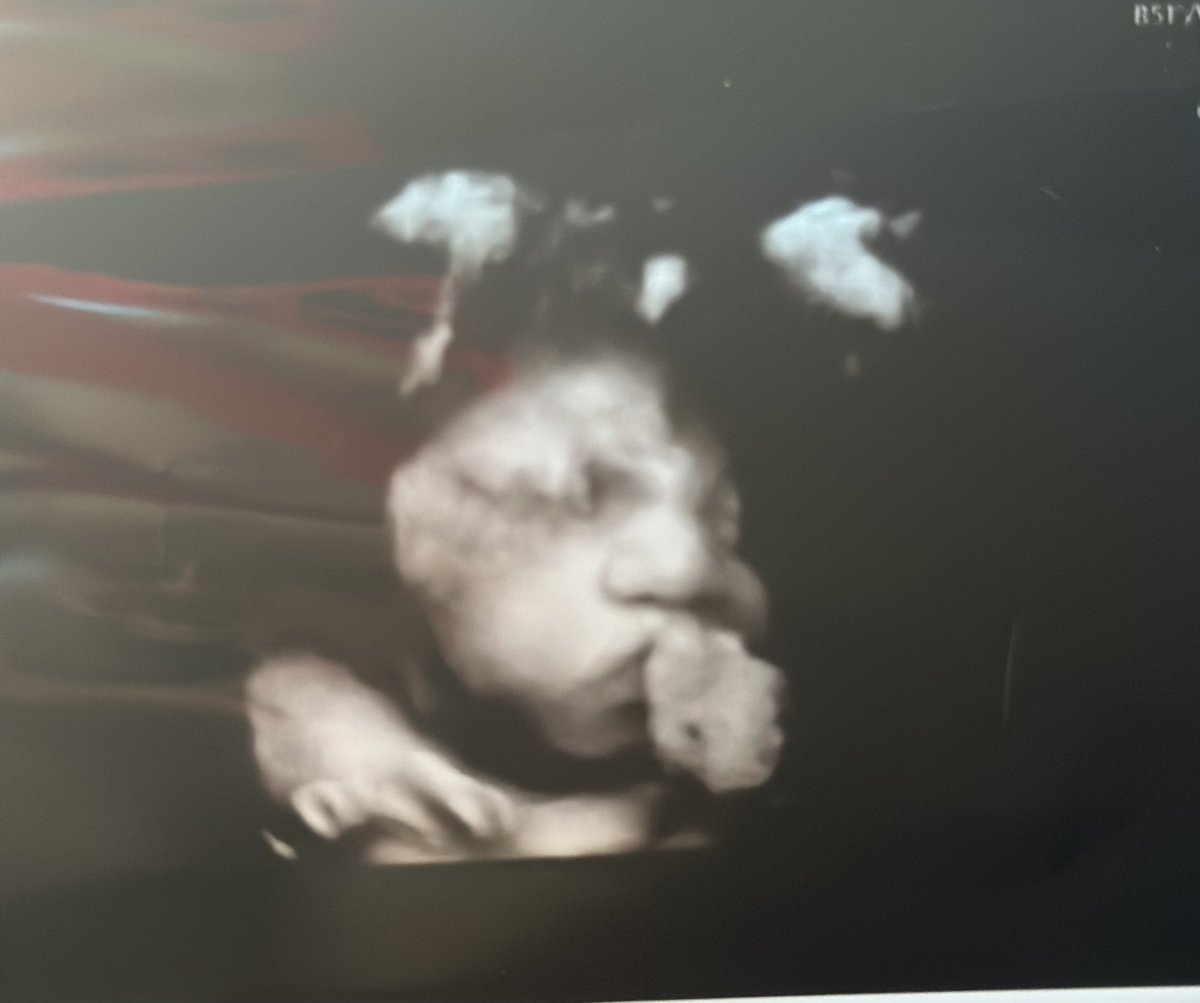 Celtics_94's tweet photo. I have officially entered my last month of pregnancy. It’s been bitter sweet! Seeing his face yesterday &amp; feeling all of his kicks &amp; turns everyday has made me sooo happy &amp;&amp; definitely can’t wait to hold him 💙💙💙🥹🥹🥹 https://t.co/67Rtmp95SE