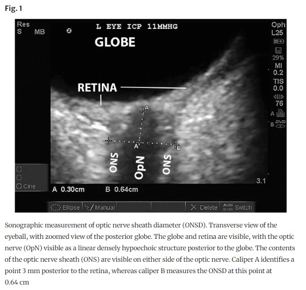 Viewpoint:

Venkatakrishna Rajajee: Noninvasive Intracranial Pressure Monitoring: Are We There Yet?

Link: ow.ly/pRFP50RoAwz

<a href="/neurocritical/">Neurocritical Care Society</a> #NeuroCritCare