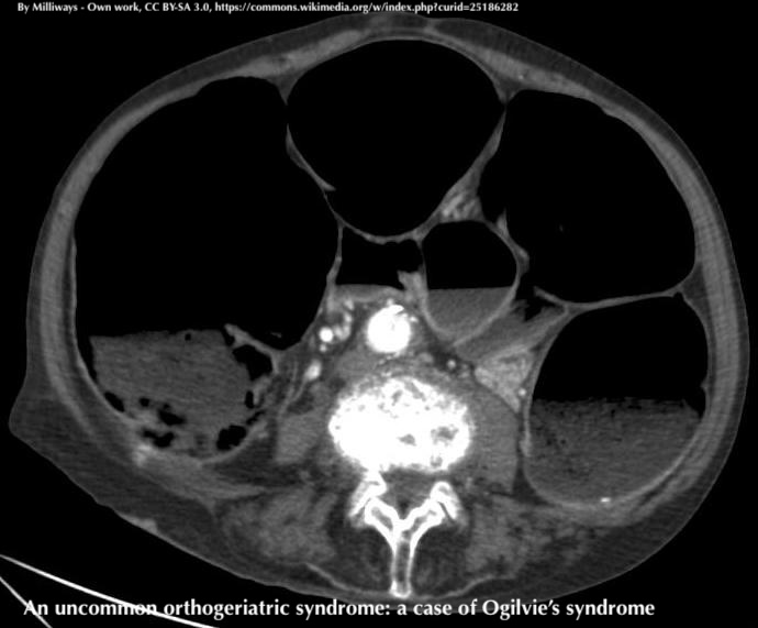 | Geriatric Care |

A case report emphasizing presence of the rare Ogilvie’s syndrome in orthogeriatric depts identifies risk factors that can be identified by #geriatric evaluation to avoid the use of anesthesiologic techniques and drugs in elderly

➡️doi.org/10.4081/gc.202…