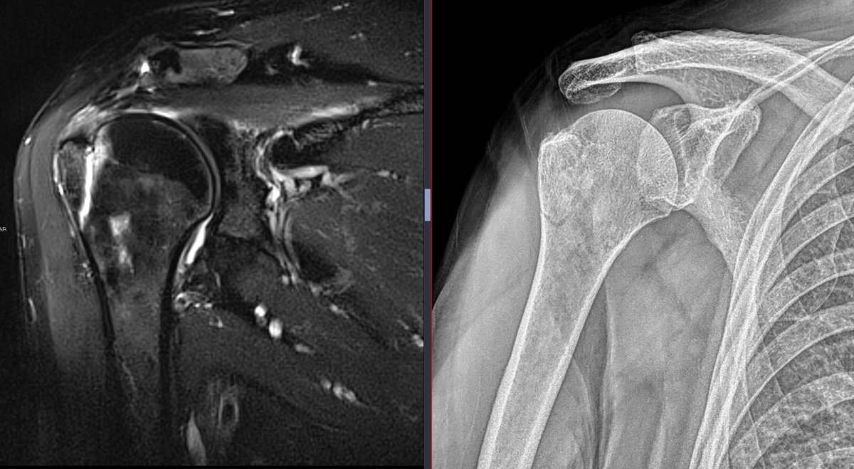 themskarchive's tweet photo. DIAGNOSIS - 5⃣Trochiter fracture.
@VinciusGarciaR2 @victorrene1969 @_mm177 @NatnaelFikadu @gotswags_oggy @JoseAlo01597710
#traumatwitter
#MSK #XRAY https://t.co/1YebxlFpaq
