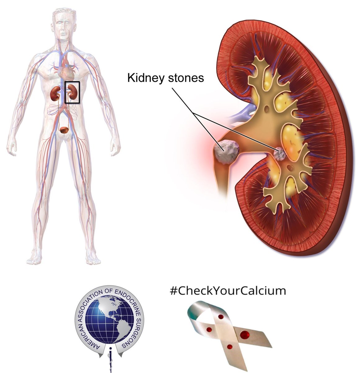 TheAAES's tweet image. Measuring urine calcium in patients with hyperparathyroidism can help to predict the risk of developing kidney stones. Kidney (renal) ultrasound can identify silent kidney stones. #CheckYourCalcium #PAM2024 @TheAACE @ParaTroupers1 @TheEndoSociety