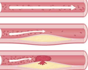 g_diets_'s tweet image. Cholesterol is not the main predictor of heart disease

The problem is chronic inflammation of blood vessels from sugar,seed oils and refine carbs

Don’t be afraid of meat including red meats, liver and organ

Don’t neglect eggs too