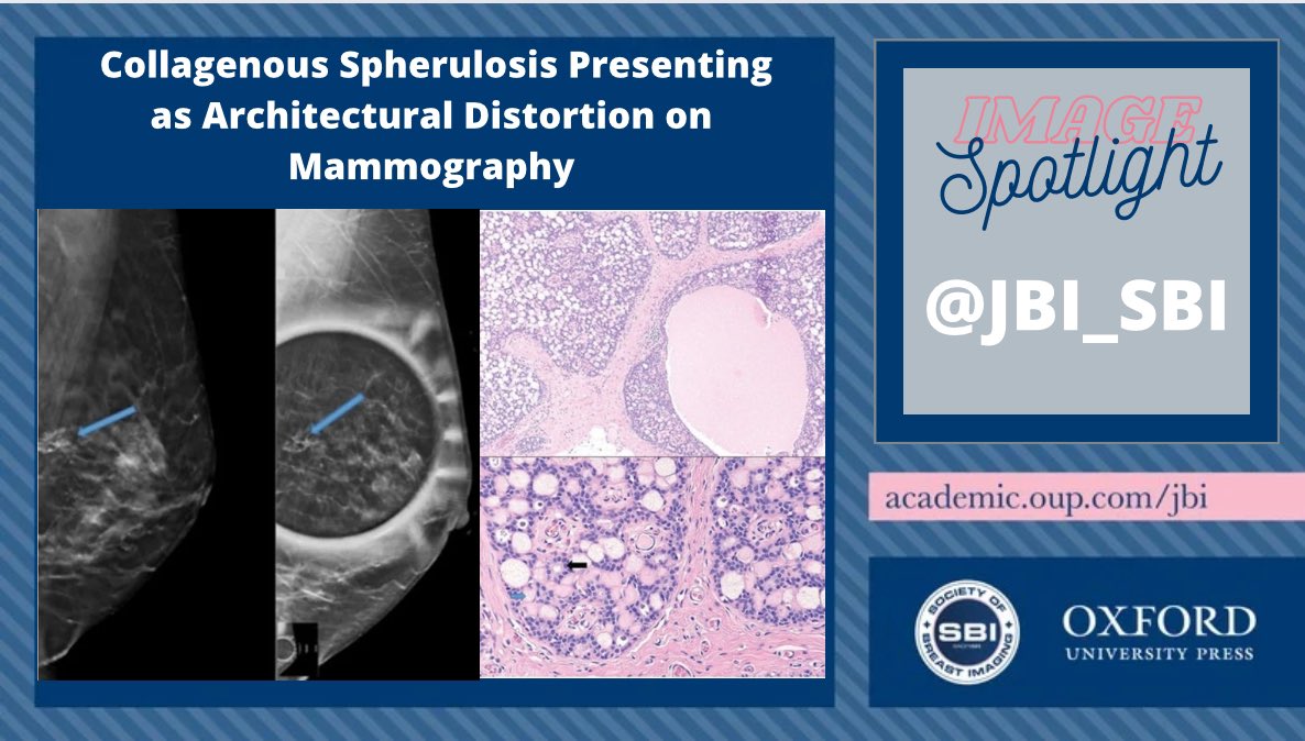 Journal of Breast Imaging (@jbi_sbi) on Twitter photo 📣📣 JBI IMAGE SPOTLIGHT 📣📣
By <a href="/amykpatel/">Amy K. Patel, MD</a>
✨Collagenous spherulosis: B9 alteration of breast epithelium
✨Incidence < 1% of all excisions
✨Histology: It should be differentiated from adenoid cystic carcinoma & cribriform DCIS
Read more 👇🏻👇🏽👇🏾
📩 doi.org/10.1093/jbi/wb… 📣📣 JBI IMAGE SPOTLIGHT 📣📣
By <a href="/amykpatel/">Amy K. Patel, MD</a>
✨Collagenous spherulosis: B9 alteration of breast epithelium
✨Incidence < 1% of all excisions
✨Histology: It should be differentiated from adenoid cystic carcinoma & cribriform DCIS
Read more 👇🏻👇🏽👇🏾
📩 doi.org/10.1093/jbi/wb…
