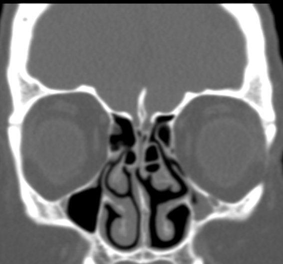 DrScottFortune's tweet photo. 55 yo F with "pressure" and "post nasal drip" comment your diagnosis, anatomic findings, and any potential problems you might encounter in surgery #Rhinology #CTscan #SinusCT #anatomy #anatomicvariants https://t.co/mQVtUEmv9X