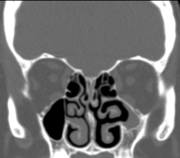 DrScottFortune's tweet photo. 55 yo F with "pressure" and "post nasal drip" comment your diagnosis, anatomic findings, and any potential problems you might encounter in surgery #Rhinology #CTscan #SinusCT #anatomy #anatomicvariants https://t.co/mQVtUEmv9X