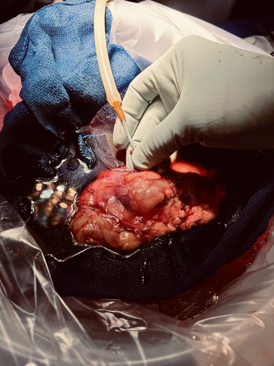 drdivsharma18's tweet photo. @ID_MUSC #TxIDFellow at MUSC Health's living donor program. "Anonymous" donates an organ, which is carefully harvested and transported to the facility in queue, where an eager recipient will receive it today. How life comes full circle. #apartofmeisnowapartofyou https://t.co/a6LnELEmL2